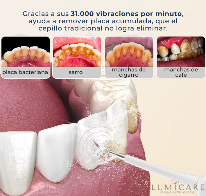 SonicClean Pro™ – Kit Dental Ultrasónico de Limpieza Profunda