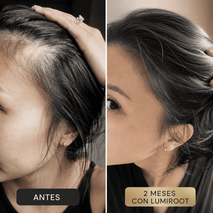 LUMIROOT™ | Estimulador de crecimiento capilar avanzado con luz roja