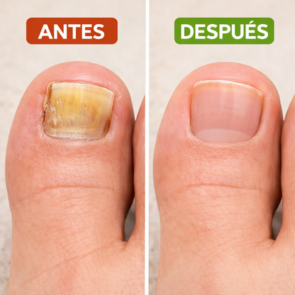 2X1 FungalNail - Parches Antihongos - Repara, Fortalece y Mejora tus Uñas