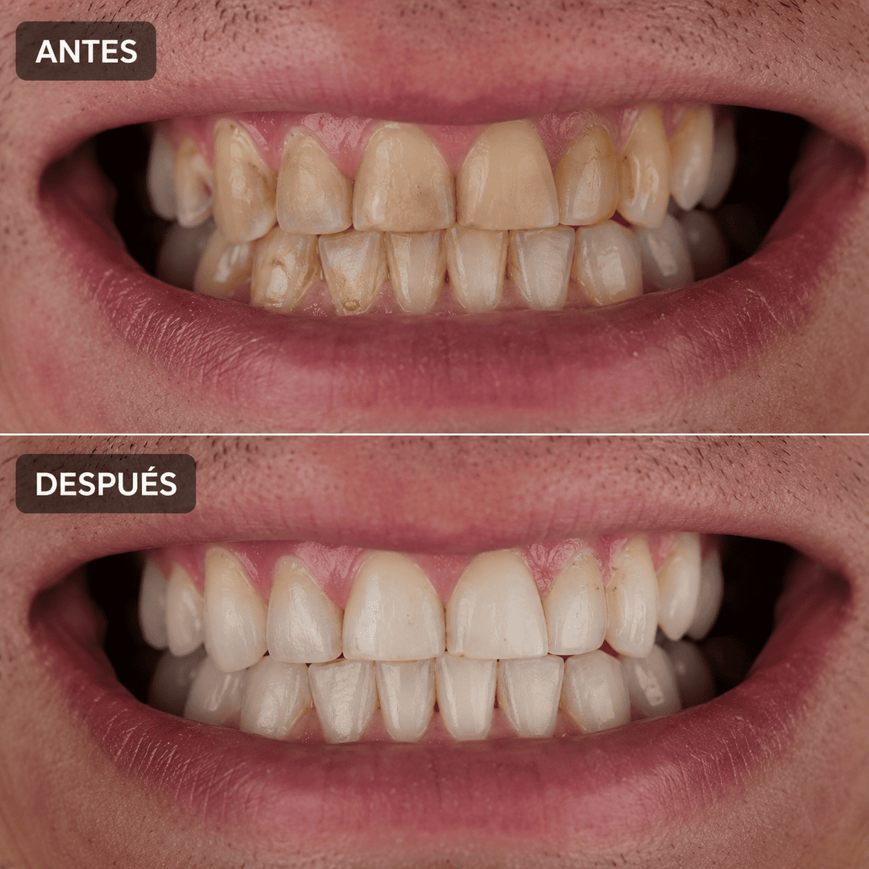 DENTAL ARMOR™ | Tecnología Nano para Reducir la Sensibilidad y Fortalecer tus Dientes